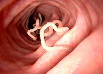 VERS INTESTINAUX 360x260