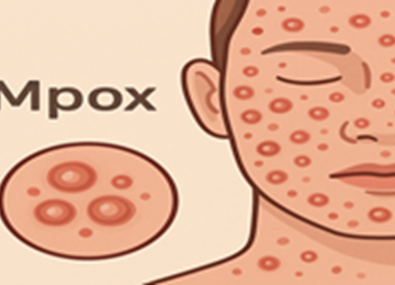 MPOX 4 360x260