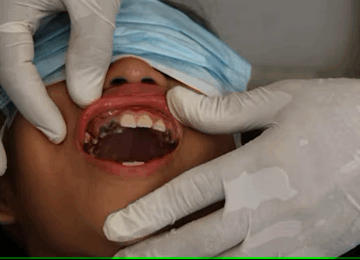 Les Caries Dentaires 360x260