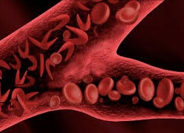 Drepanocytose 360x260